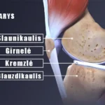 KAIP ELGTIS KELIO SĄNARIO PAŽEIDIMO ATVEJU? 2 Kelio Sąnario Kineziterapja Klapeda
