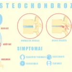 STUBURO OSTEOCHONDROZĖ 5 Osteochondrozes Kinezoterapija