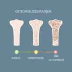 KAULŲ SVEIKATA IR OSTEOPOROZĖ: KĄ TURĖTUME ŽINOTI? 5 Osteoporoze